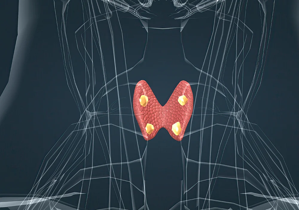 Hiperparatireoidismo: Sintomas, Diagnóstico e Tratamento Completo